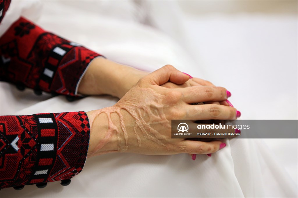 Acid attack victims model for Iranian fashion designer