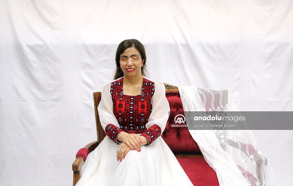 Acid attack victims model for Iranian fashion designer