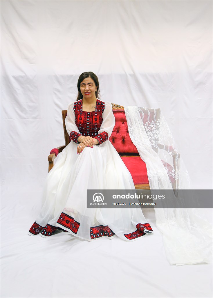 Acid attack victims model for Iranian fashion designer