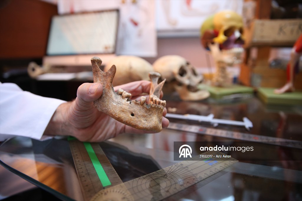 Körtik Tepe'den çıkarılan Orta Çağ dönemine ait kemikler cerrahi çalışmalara ışık tutacak