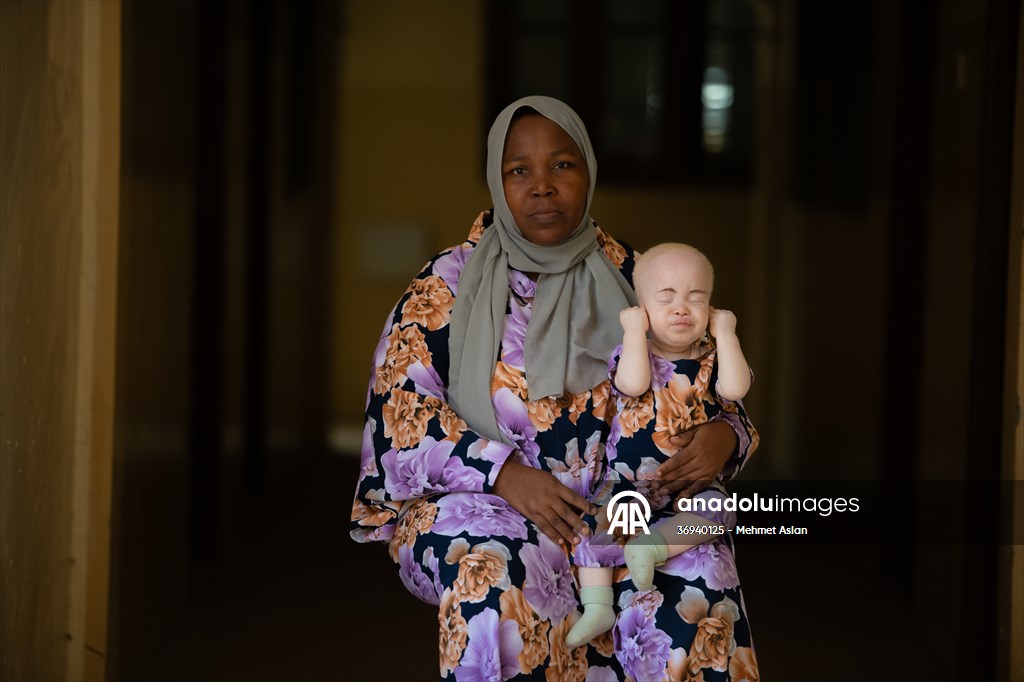 Albino children in Zanzibar