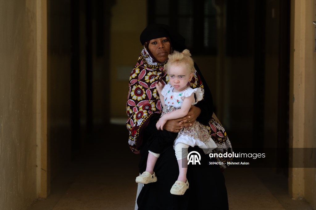 Albino children in Zanzibar