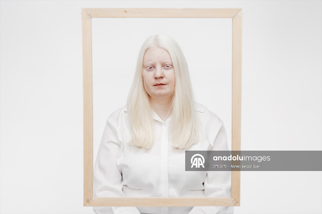 Dünya Nadir Hastalıklar Günü: 'Albino olmak'