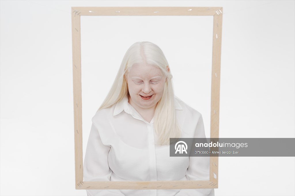 Dünya Nadir Hastalıklar Günü: 'Albino olmak'