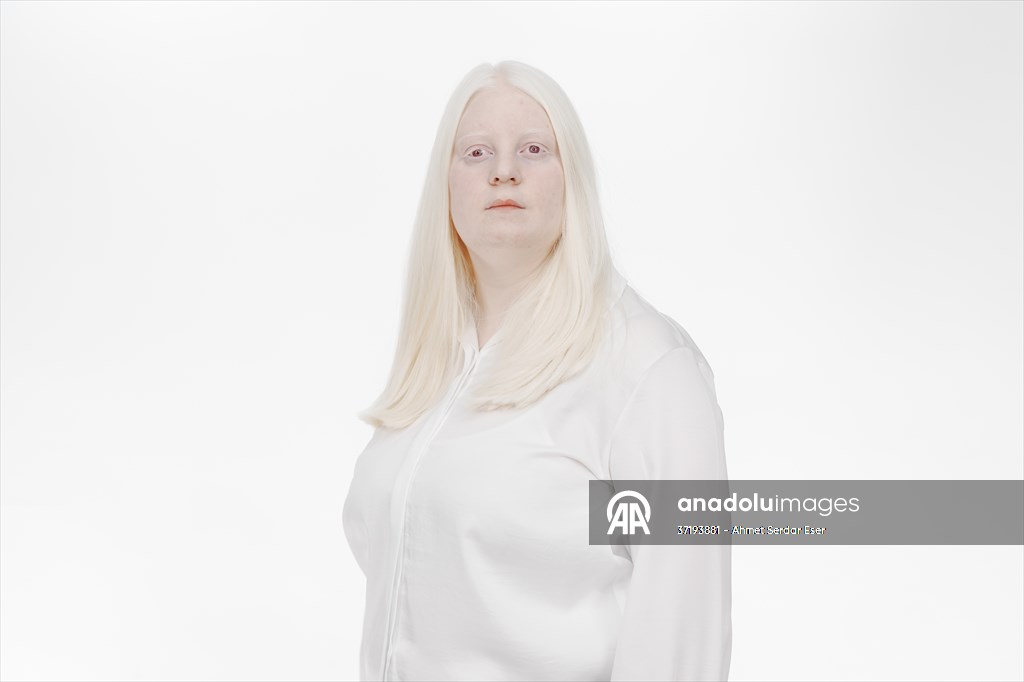 Dünya Nadir Hastalıklar Günü: 'Albino olmak'