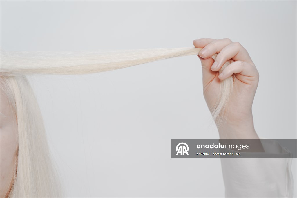 Dünya Nadir Hastalıklar Günü: 'Albino olmak'