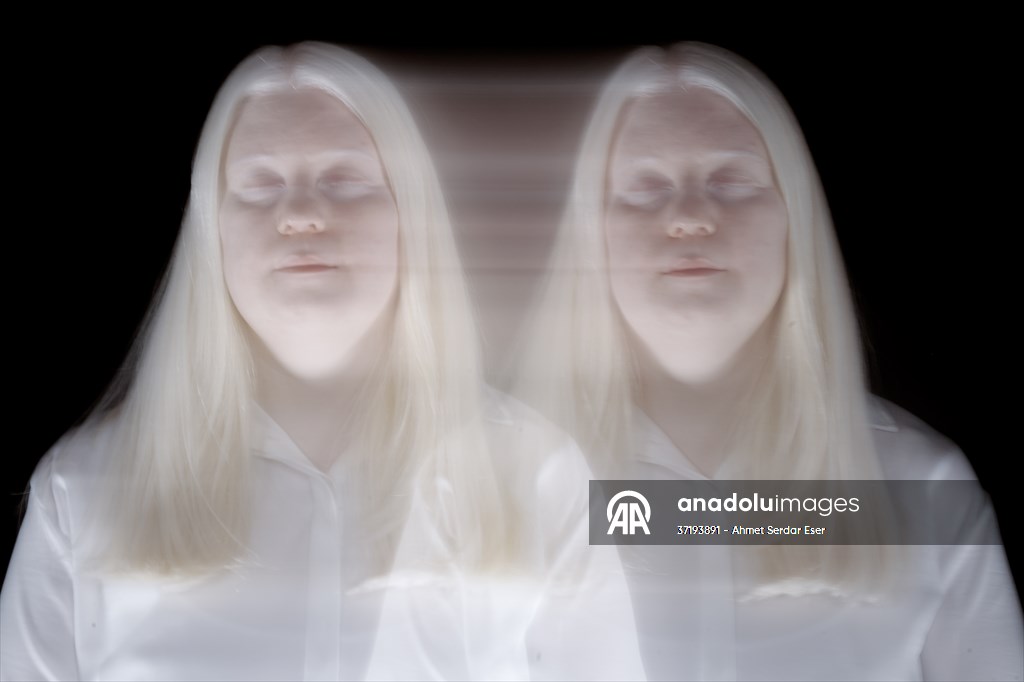 Dünya Nadir Hastalıklar Günü: 'Albino olmak'