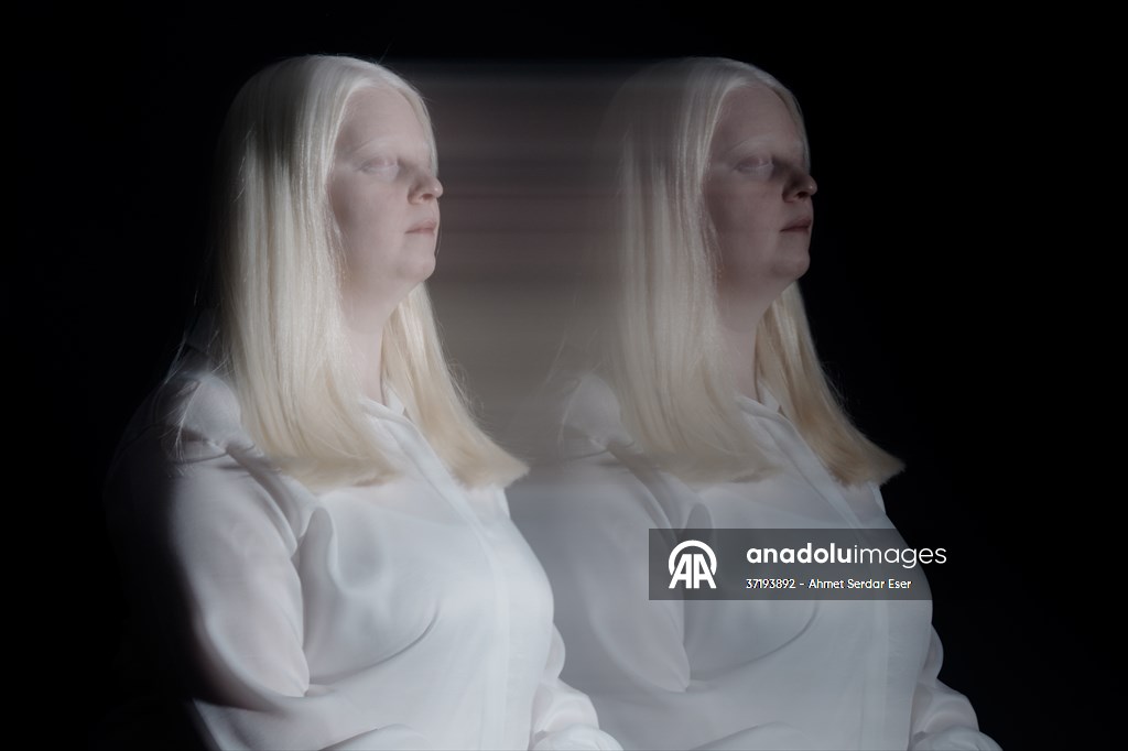 Dünya Nadir Hastalıklar Günü: 'Albino olmak'
