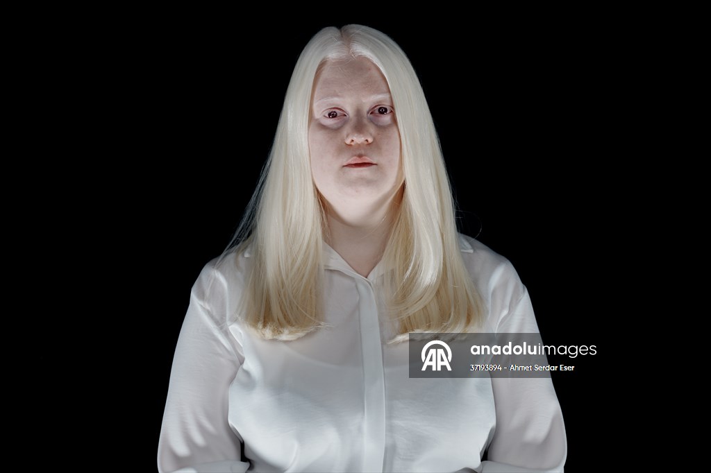 Dünya Nadir Hastalıklar Günü: 'Albino olmak'