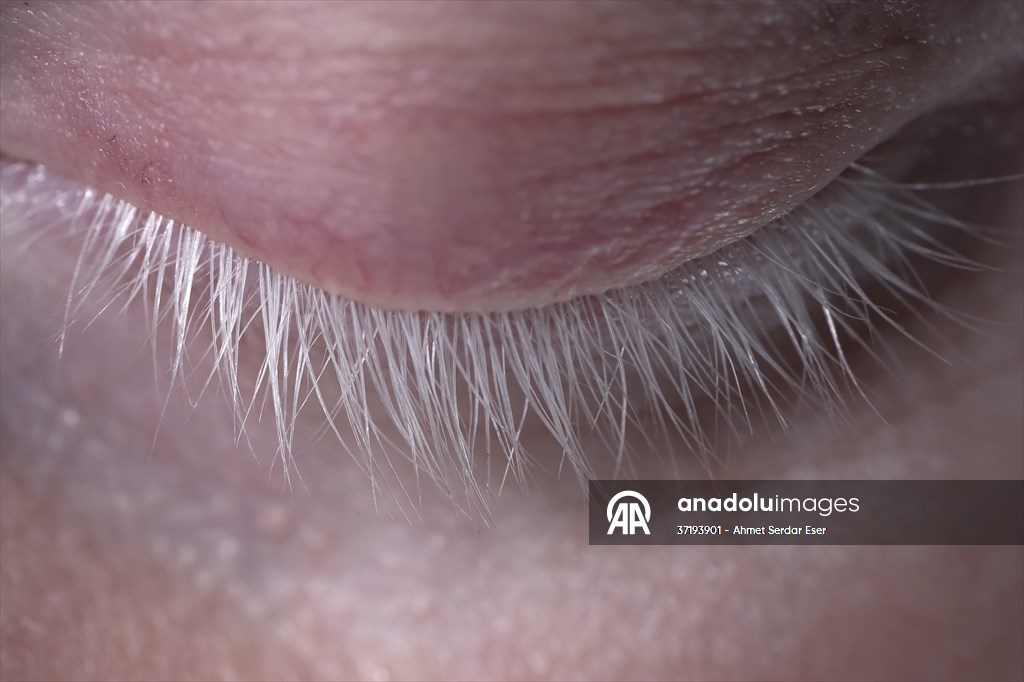 Dünya Nadir Hastalıklar Günü: 'Albino olmak'