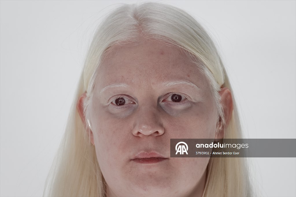 Dünya Nadir Hastalıklar Günü: 'Albino olmak'