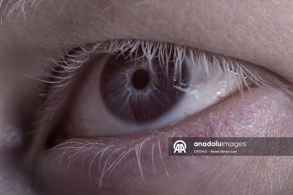 Dünya Nadir Hastalıklar Günü: 'Albino olmak'