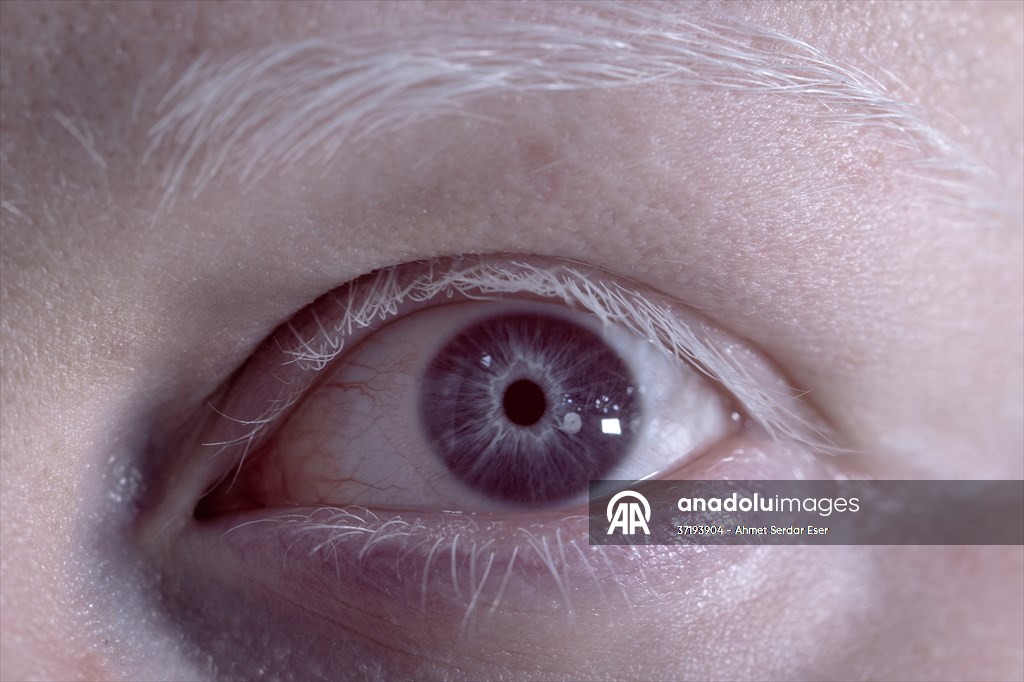 Dünya Nadir Hastalıklar Günü: 'Albino olmak'