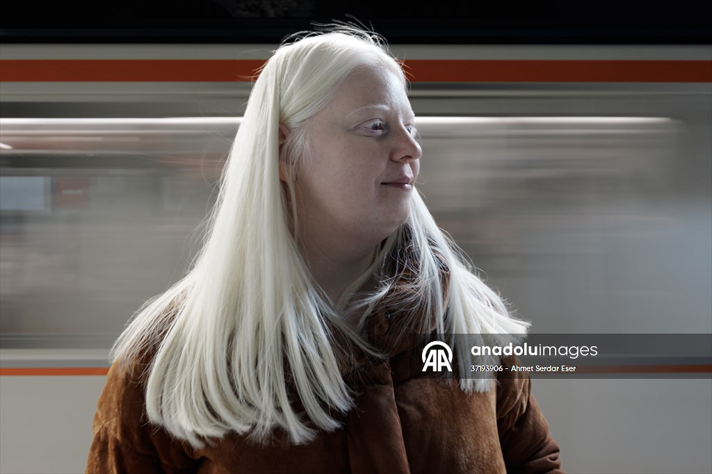 Dünya Nadir Hastalıklar Günü: 'Albino olmak'