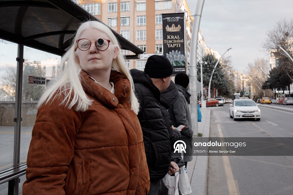 Dünya Nadir Hastalıklar Günü: 'Albino olmak'