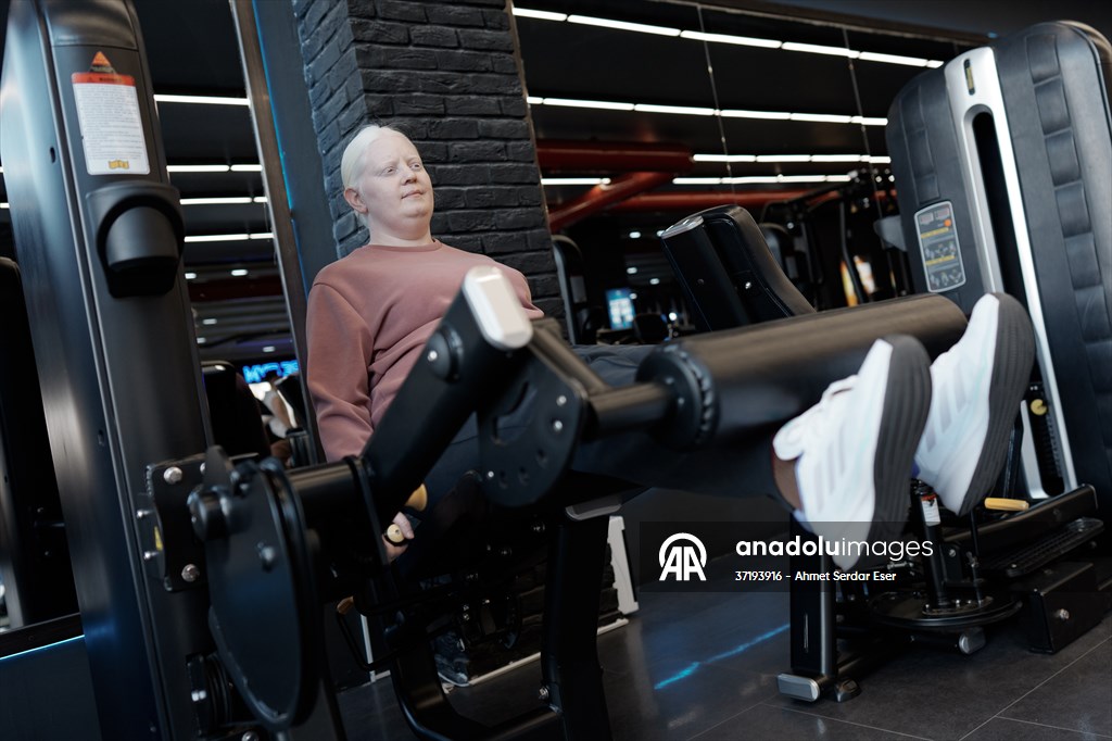 Dünya Nadir Hastalıklar Günü: 'Albino olmak'