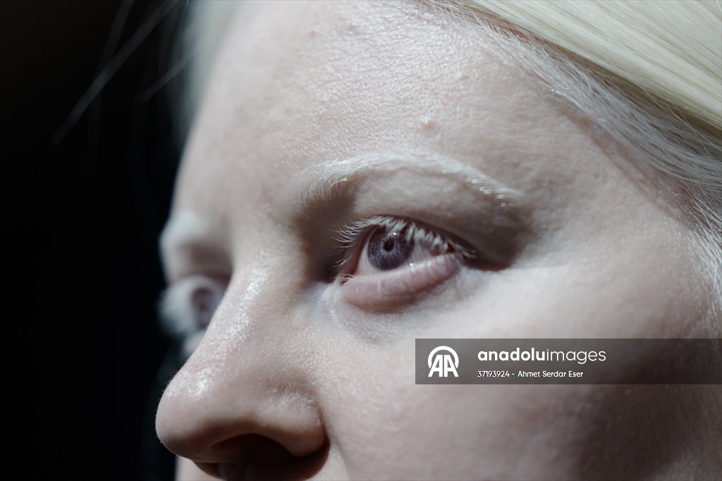 Dünya Nadir Hastalıklar Günü: 'Albino olmak'