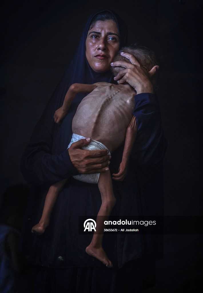 Palestinian baby in Gaza suffering from malnutrition at risk of death