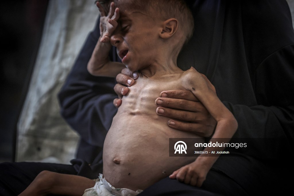 Palestinian baby in Gaza suffering from malnutrition at risk of death