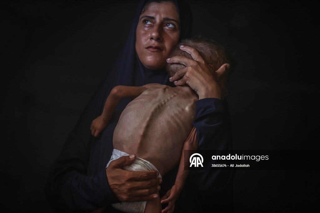 Palestinian baby in Gaza suffering from malnutrition at risk of death