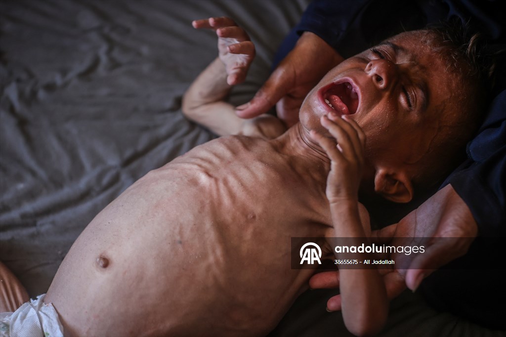 Palestinian baby in Gaza suffering from malnutrition at risk of death