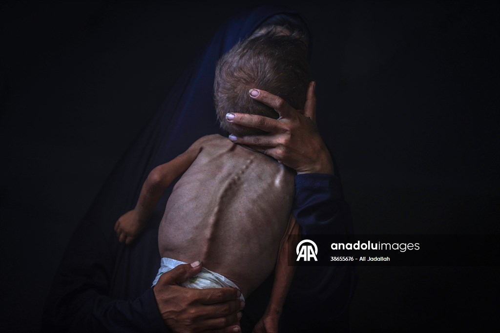 Palestinian baby in Gaza suffering from malnutrition at risk of death