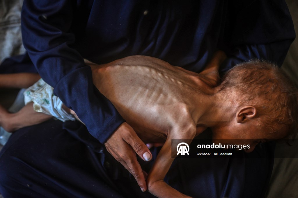 Palestinian baby in Gaza suffering from malnutrition at risk of death