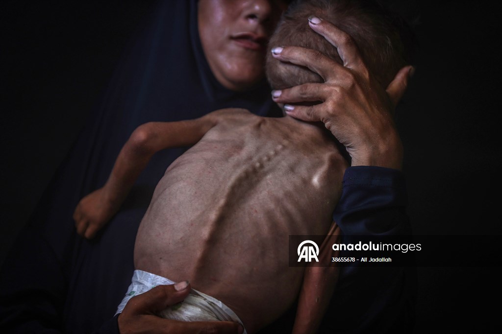 Palestinian baby in Gaza suffering from malnutrition at risk of death