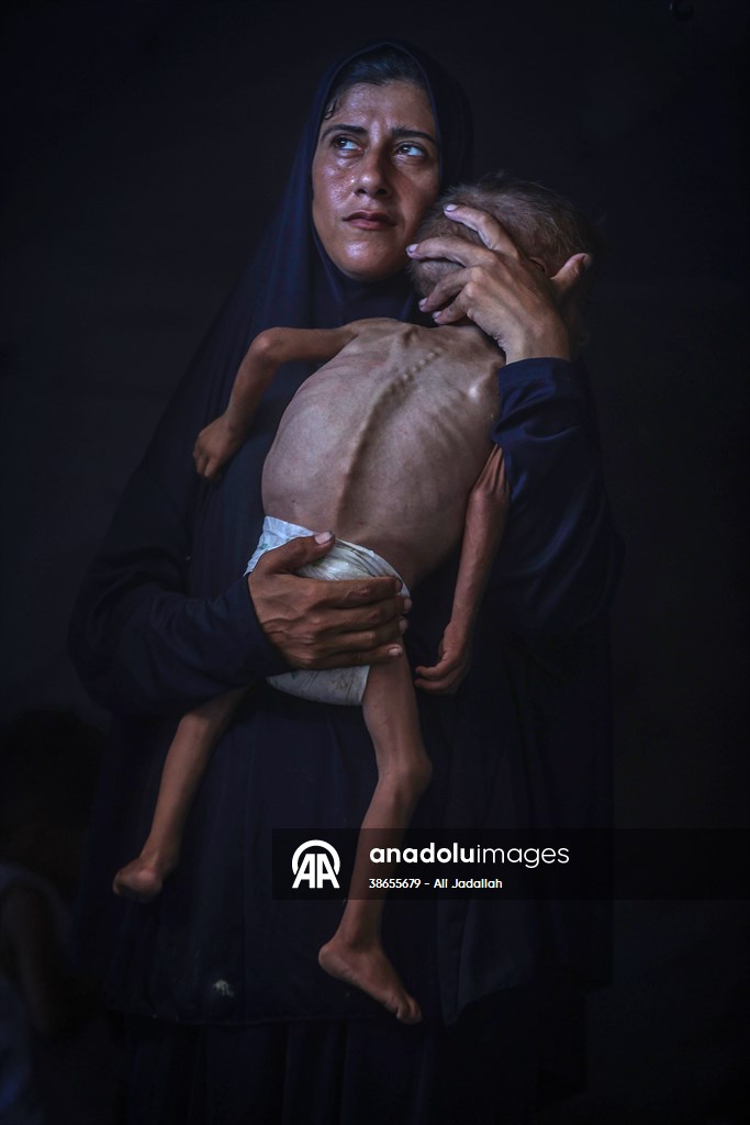 Palestinian baby in Gaza suffering from malnutrition at risk of death