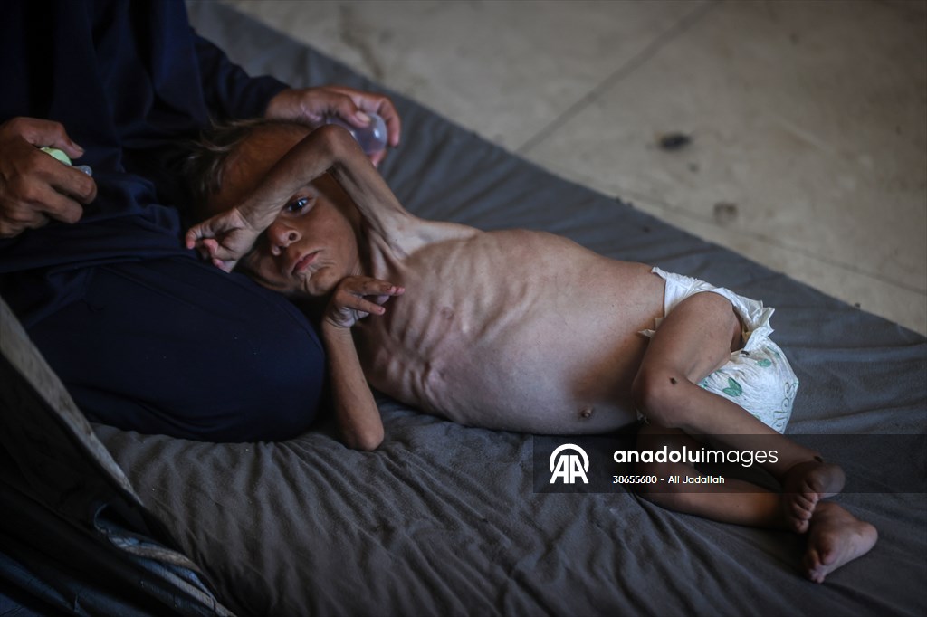 Palestinian baby in Gaza suffering from malnutrition at risk of death