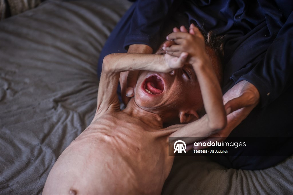 Palestinian baby in Gaza suffering from malnutrition at risk of death