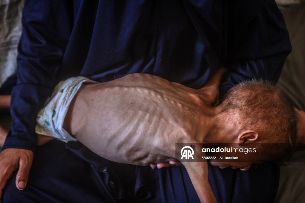 Palestinian baby in Gaza suffering from malnutrition at risk of death