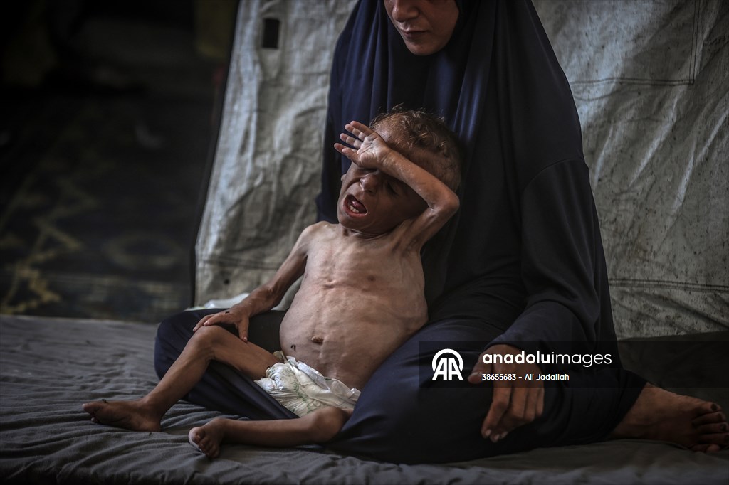Palestinian baby in Gaza suffering from malnutrition at risk of death