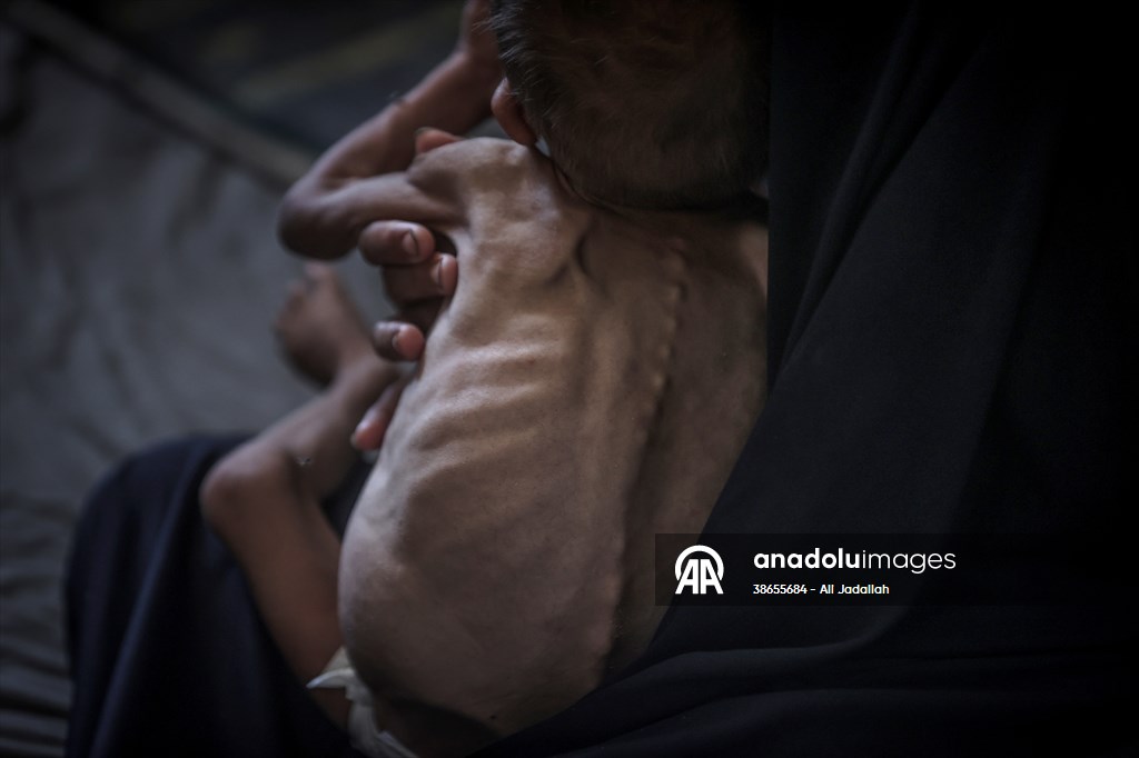Palestinian baby in Gaza suffering from malnutrition at risk of death