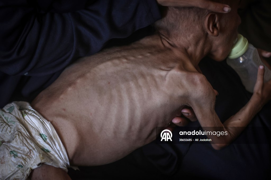 Palestinian baby in Gaza suffering from malnutrition at risk of death