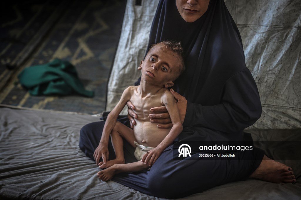 Palestinian baby in Gaza suffering from malnutrition at risk of death