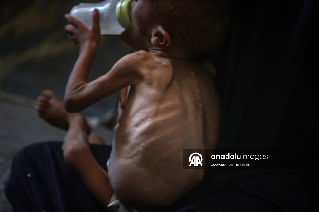 Palestinian baby in Gaza suffering from malnutrition at risk of death