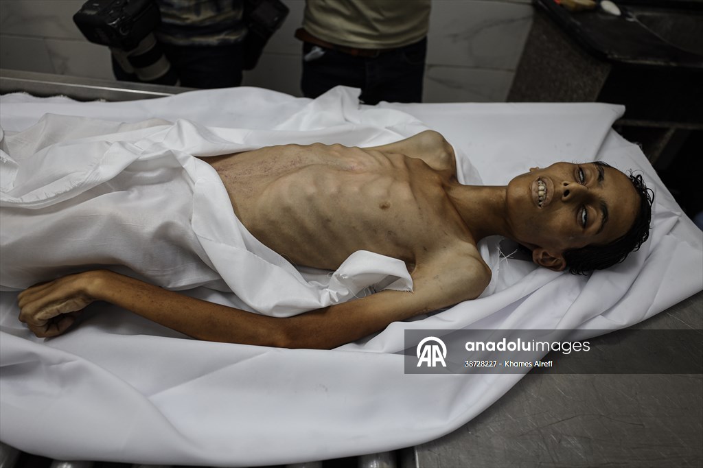 17-year-old boy dies in Gaza due to malnutrition