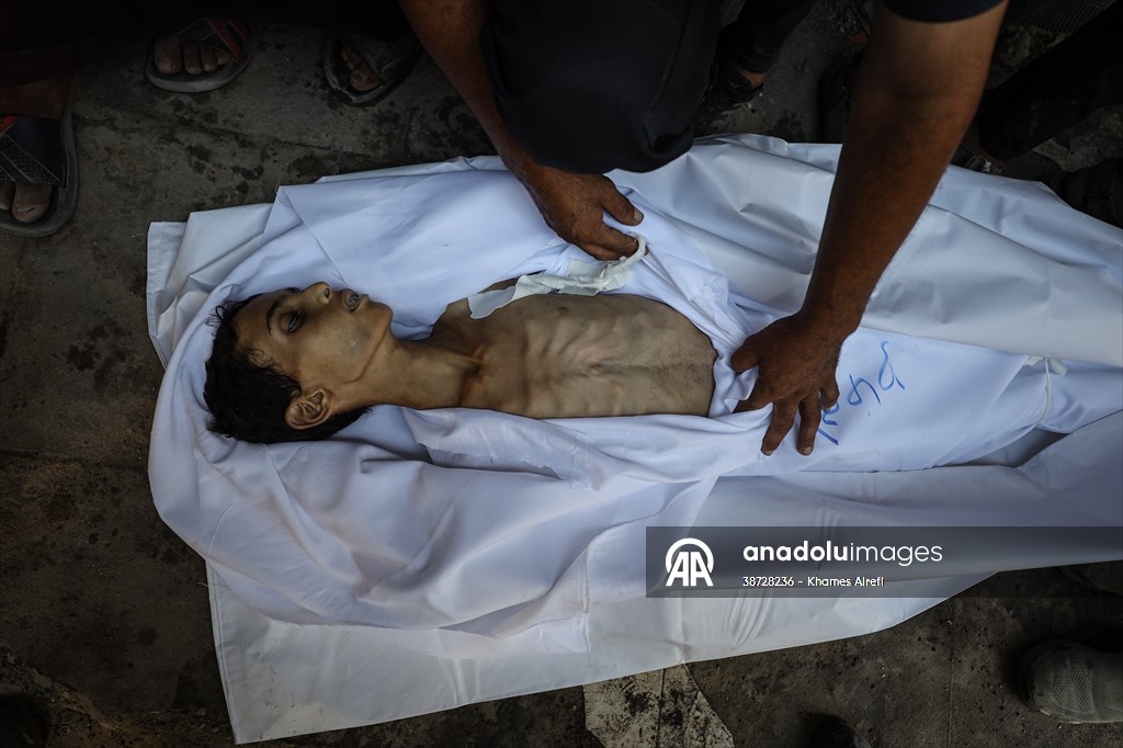 17-year-old boy dies in Gaza due to malnutrition