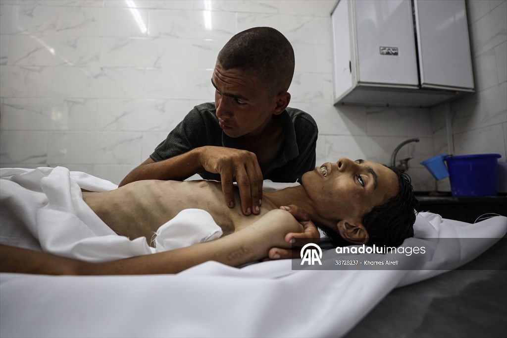 17-year-old boy dies in Gaza due to malnutrition