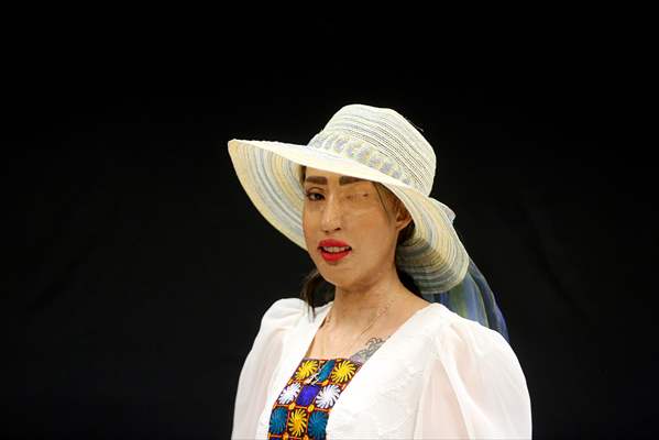 Acid attack victims model for Iranian fashion designer