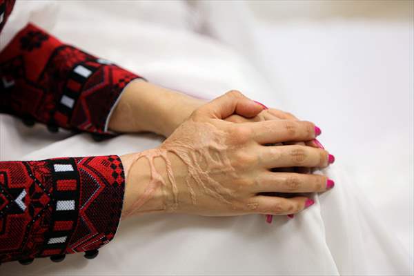 Acid attack victims model for Iranian fashion designer
