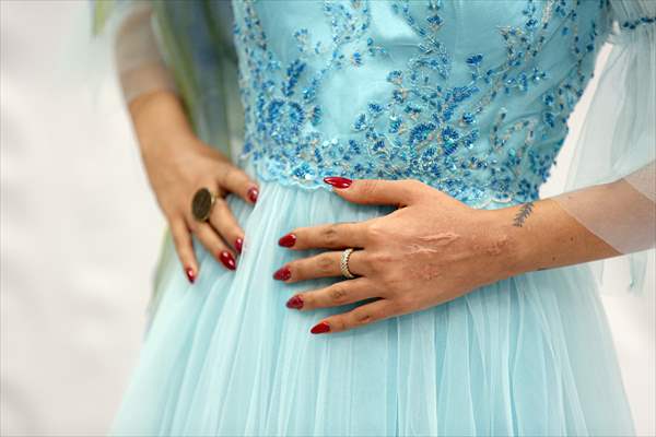 Acid attack victims model for Iranian fashion designer