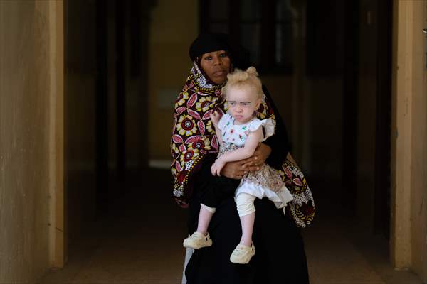 Albino children in Zanzibar