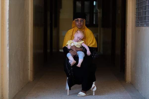 Albino children in Zanzibar