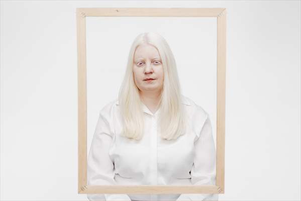 Dünya Nadir Hastalıklar Günü: 'Albino olmak'
