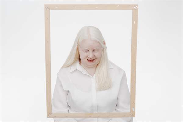 Dünya Nadir Hastalıklar Günü: 'Albino olmak'