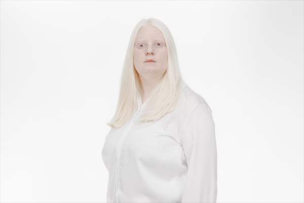 Dünya Nadir Hastalıklar Günü: 'Albino olmak'