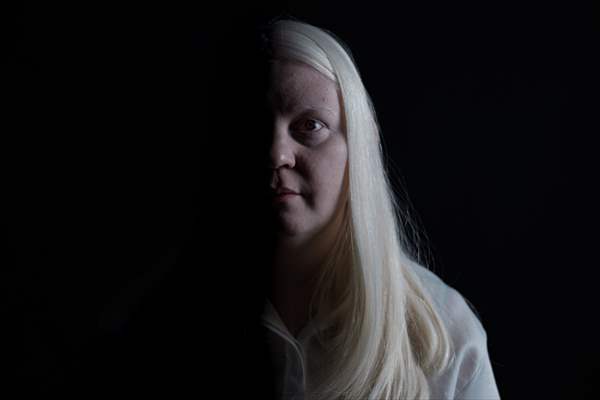 Dünya Nadir Hastalıklar Günü: 'Albino olmak'