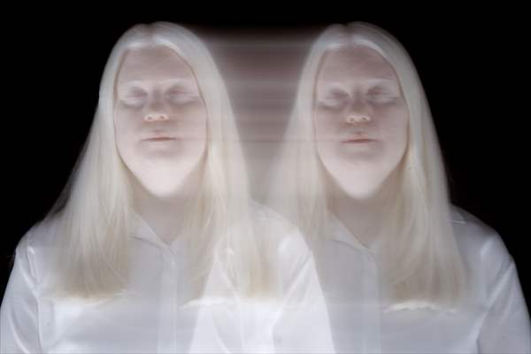 Dünya Nadir Hastalıklar Günü: 'Albino olmak'